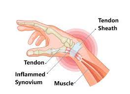 De Quervains Tenosynovitis Treatment in Hyderabad