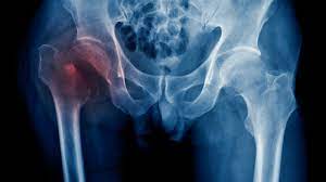 Hip Fracture Treatment
