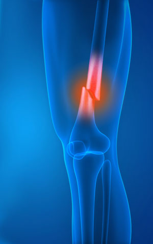 Knee Fracture Surgery in Hyderabad