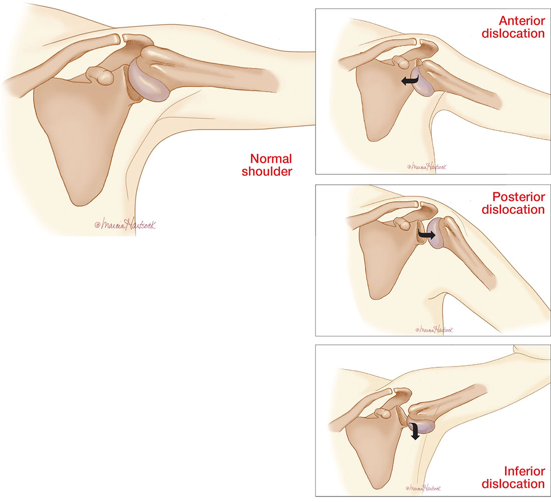 Shoulder Dislocation Treatment in Hyderabad