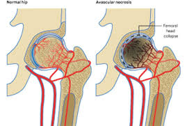 Treatment for Avascular Necrosis of Hip